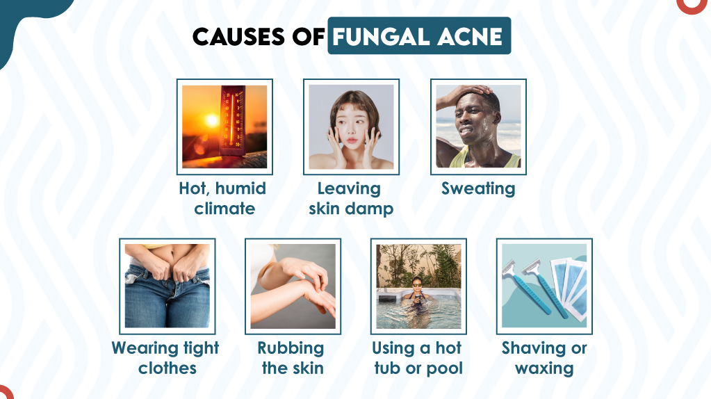 Causes of Fungal Acne