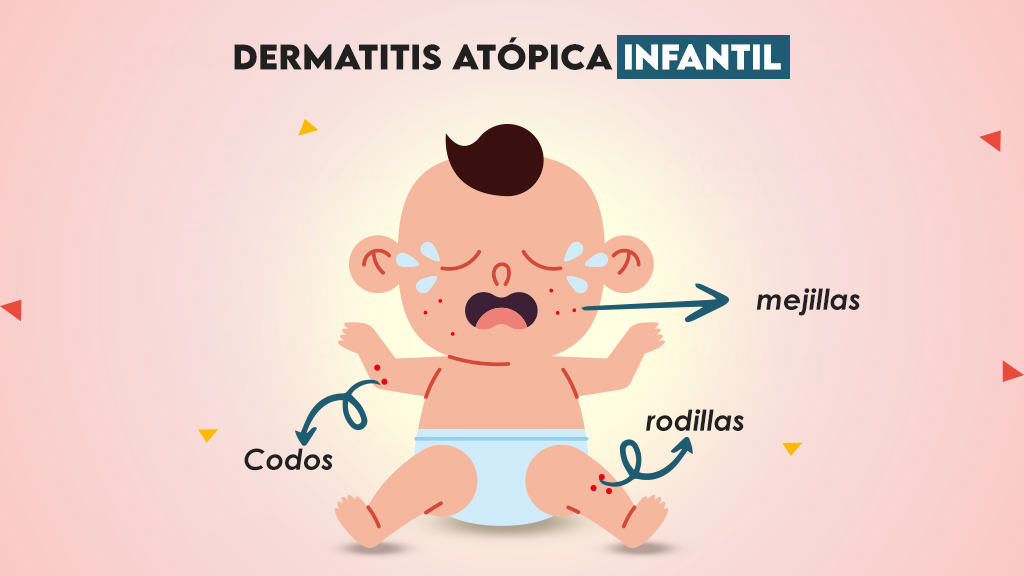 Dermatitis atópica infantil