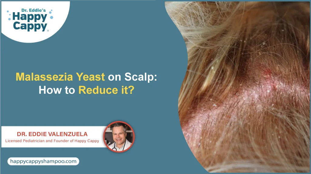 Malassezia Yeast on Scalp: How to Reduce it?