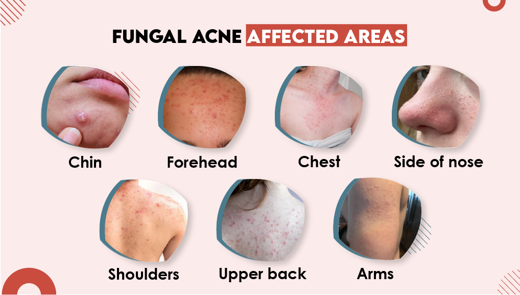 Fungal Acne Affected Areas