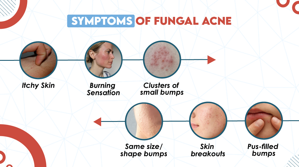 Symptoms of Fungal Acne