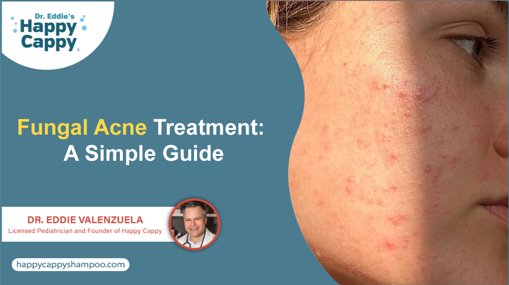 Fungal Acne Treatment: A Simple Guide