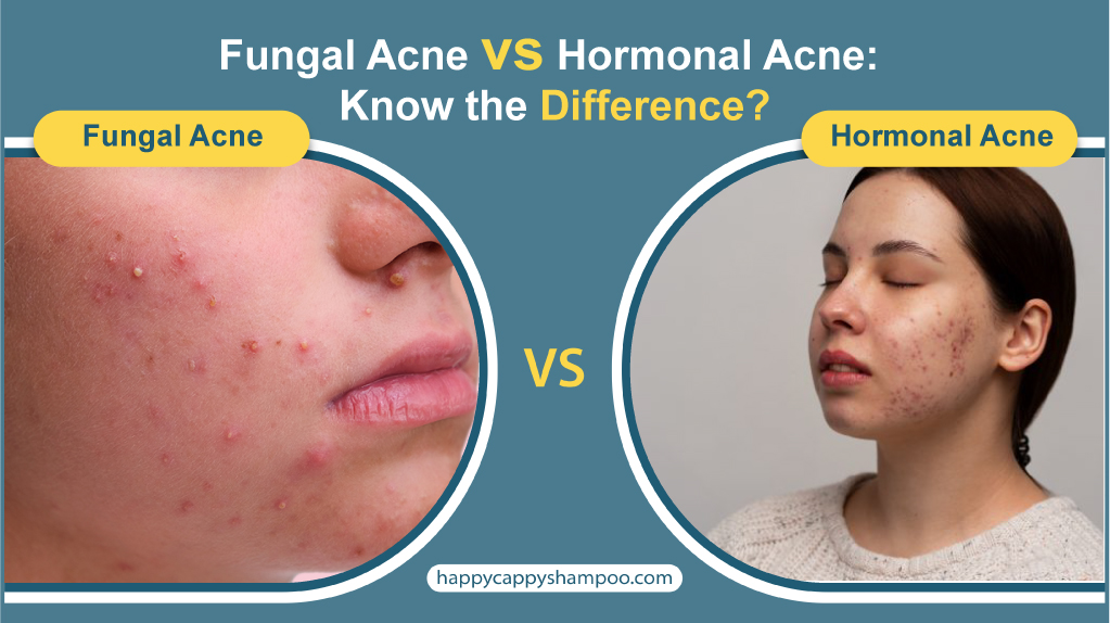 Fungal Acne vs Hormonal Acne: Know the Difference