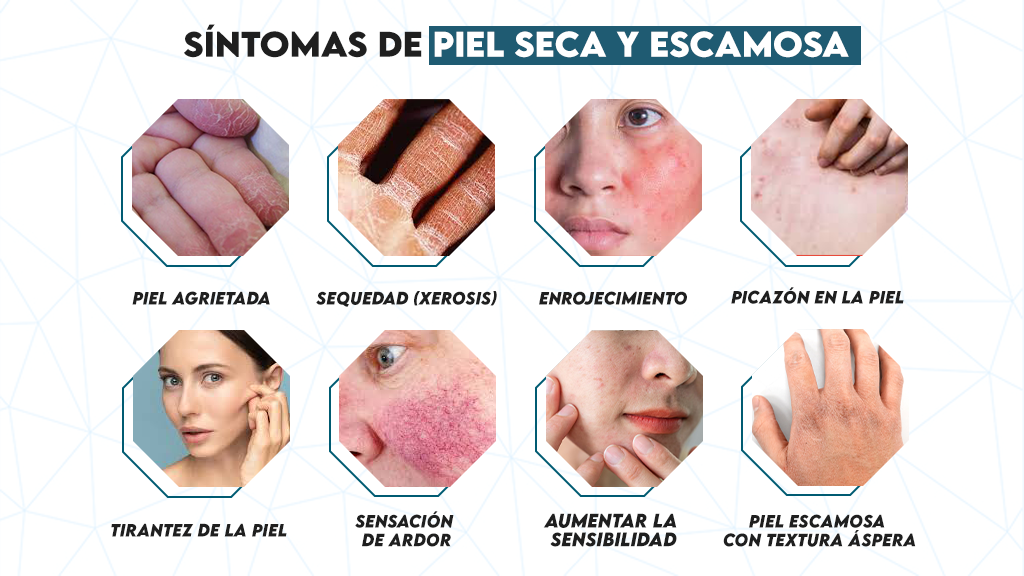 Síntomas de piel seca y escamosa