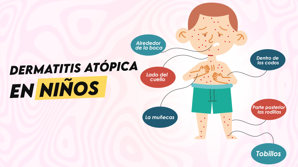 Dermatitis atópica en niños