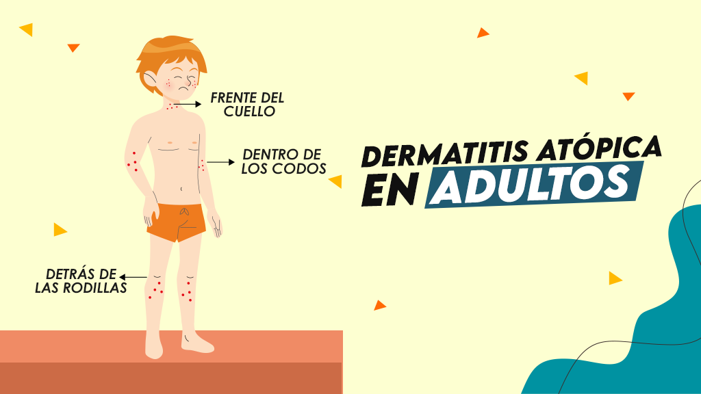 Dermatitis atópica en adultos