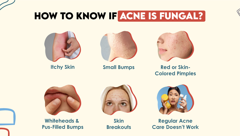 How to Know if Acne is Fungal?