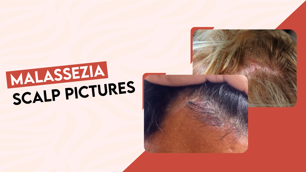 Malassezia Scalp Pictures