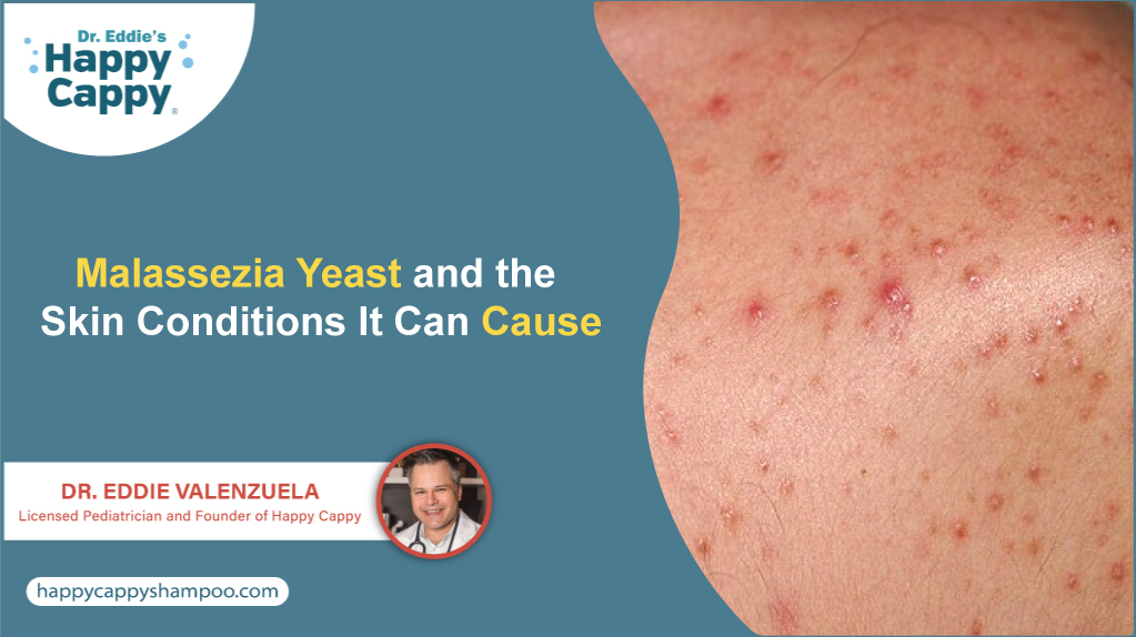 Malassezia Yeast and the Skin Conditions It Can Cause