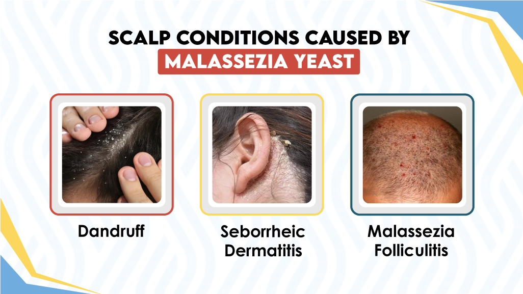 Scalp Conditions Caused by Malassezia Yeast