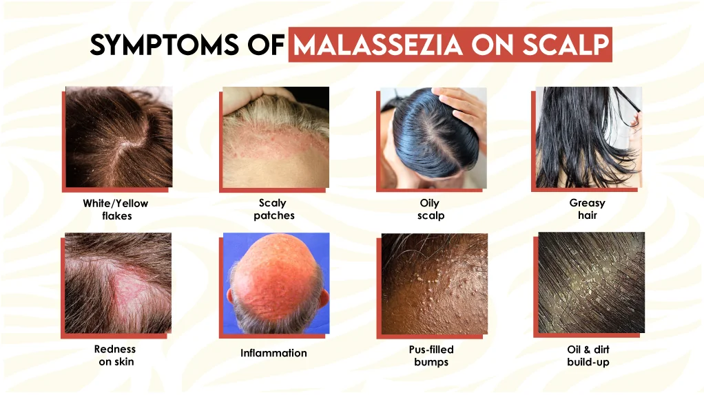 Symptoms of Malassezia on Scalp