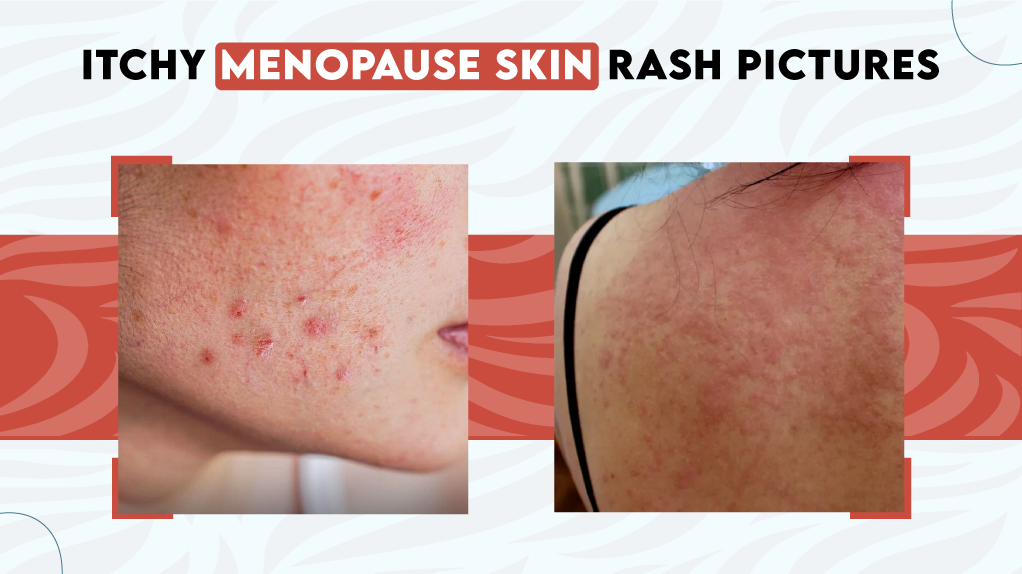 Itchy Menopause Skin Rash Pictures