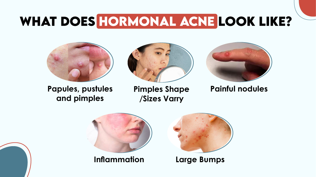 What Does Hormonal Acne Look Like? 