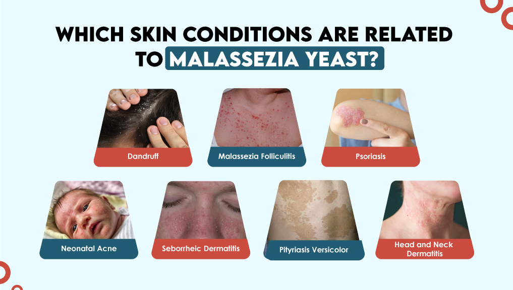 Which Skin Conditions Are Related to Malassezia Yeast?