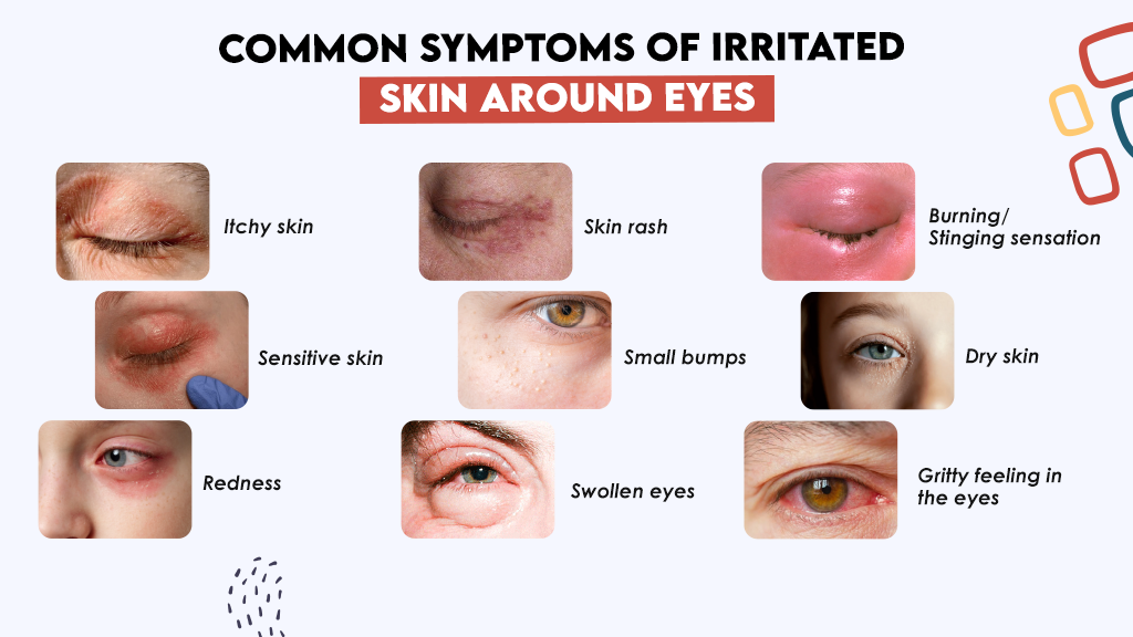 Common Symptoms of Irritated Skin Around Eyes Common Symptoms of Irritated Skin Around Eyes