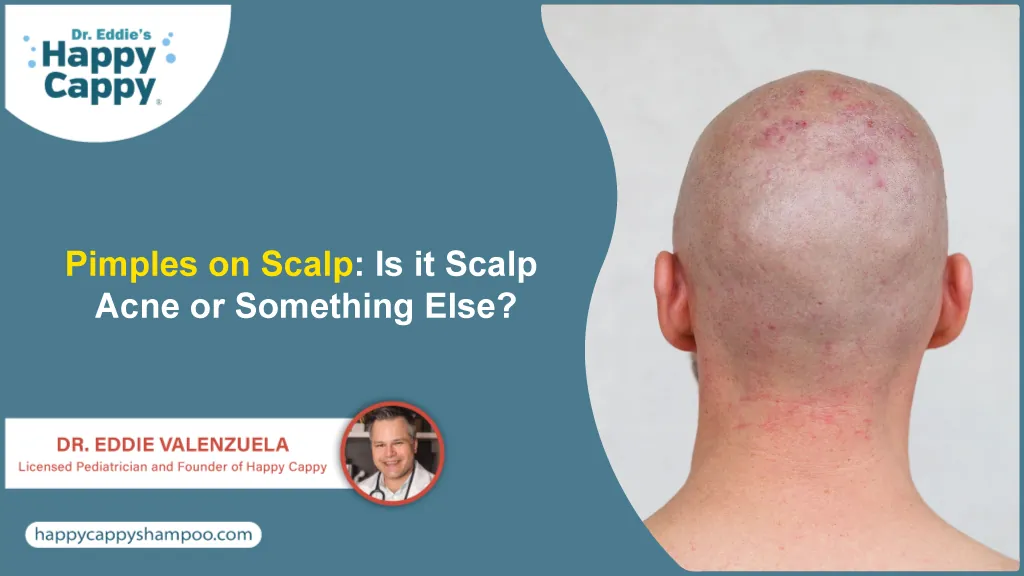 Pimples on Scalp: Is it Scalp Acne or Something Else?