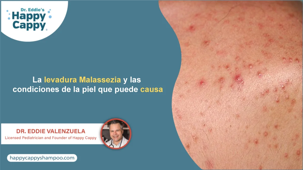 La levadura Malassezia y las condiciones de la piel que puede causa