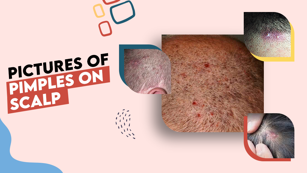 Pictures of Pimples on Scalp Pictures of Pimples on Scalp
