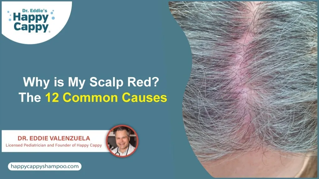 Why is My Scalp Red? The 12 Common Causes