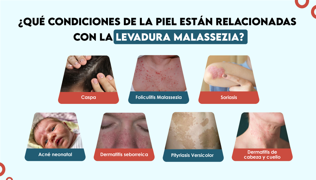 ¿Qué condiciones de la piel están relacionadas con la levadura Malassezia?