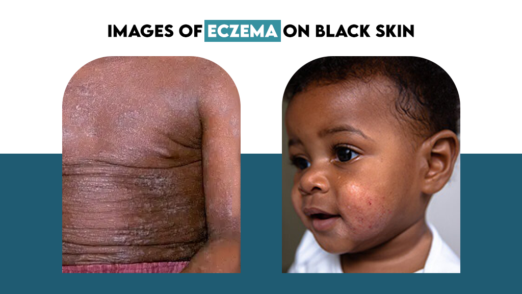 Images of Eczema on Black Skin