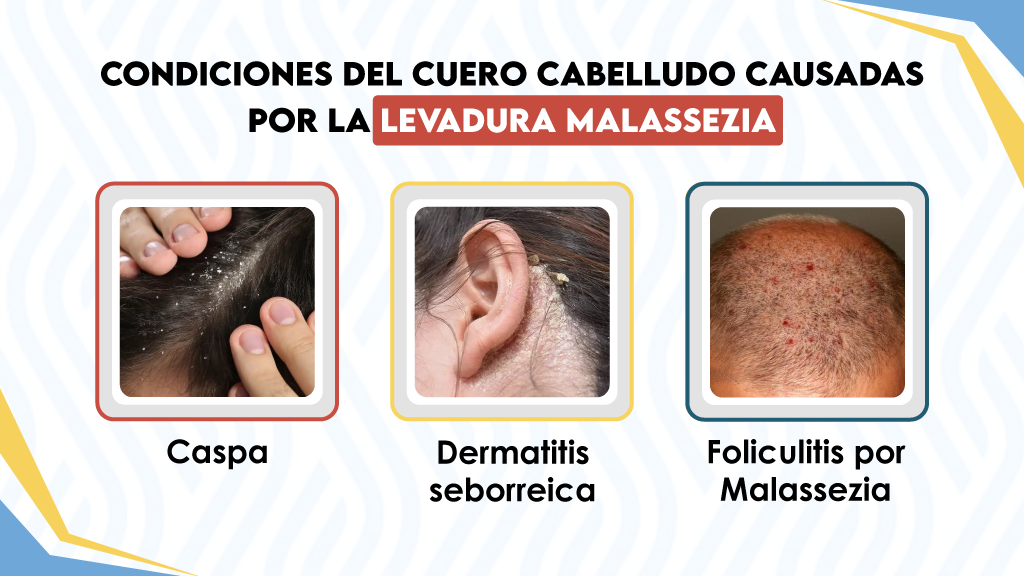 Condiciones del cuero cabelludo causadas por la levadura Malassezia