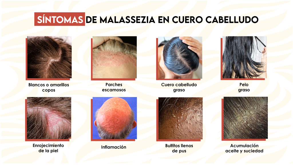 Síntomas de Malassezia en cuero cabelludo