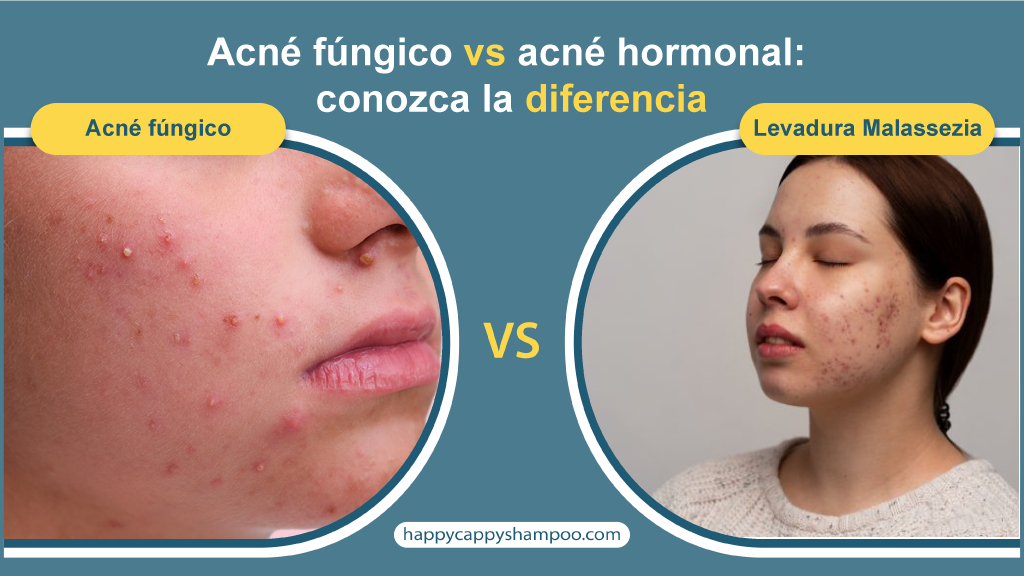 Acné fúngico vs acné hormonal: conozca la diferencia