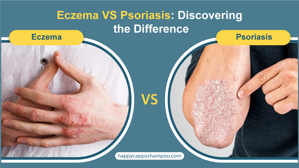 Eczema VS Psoriasis: Discovering the Difference