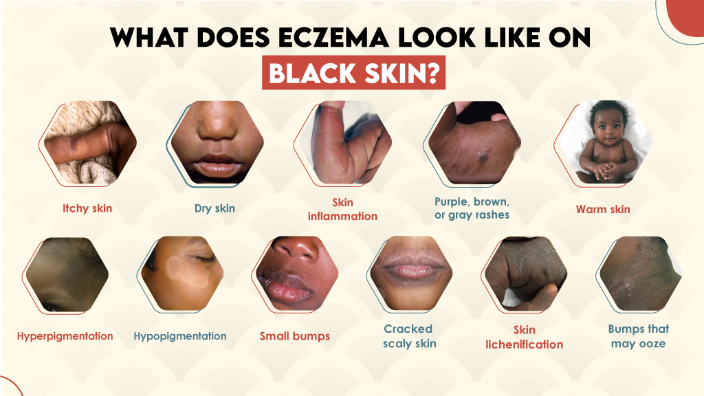 What Does Eczema Look Like on Black Skin? 