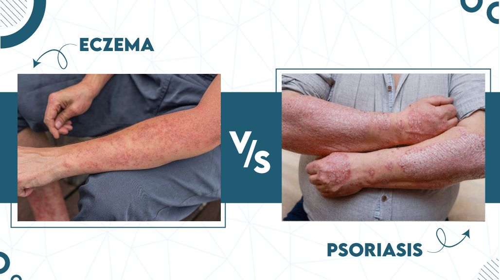 Pictures of Eczema vs Psoriasis 