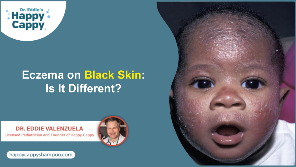 Eczema on Black Skin: Is It Different?