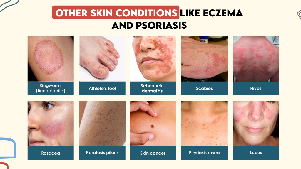 Other Skin Conditions like Eczema and Psoriasis 