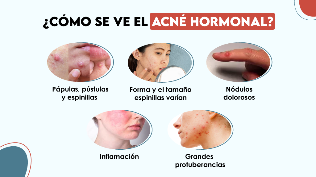 ¿Cómo se ve el acné hormonal?