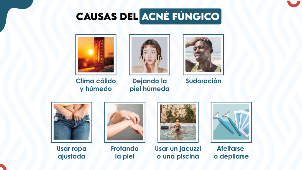 Causas del acné fúngico