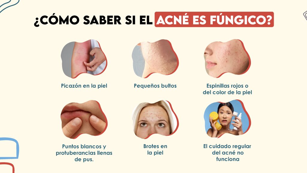 ¿Cómo saber si el acné es fúngico? ¿Cómo saber si el acné es fúngico?