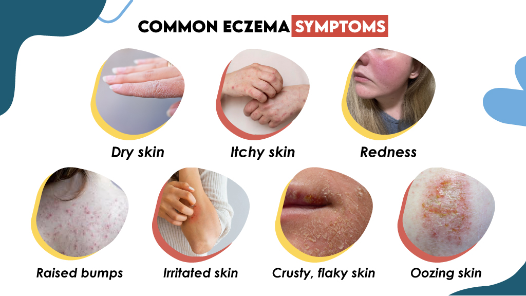 Common Eczema Symptoms