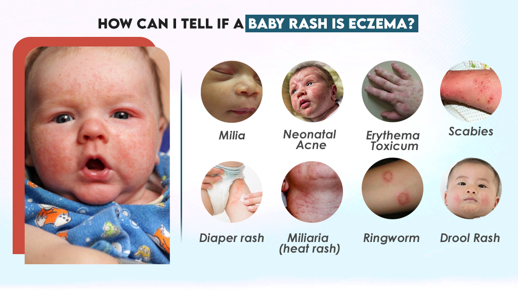 How can I tell if a baby rash is Eczema?
