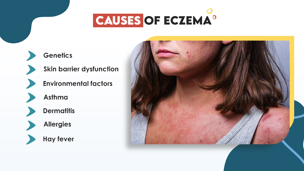 What Causes Eczema?