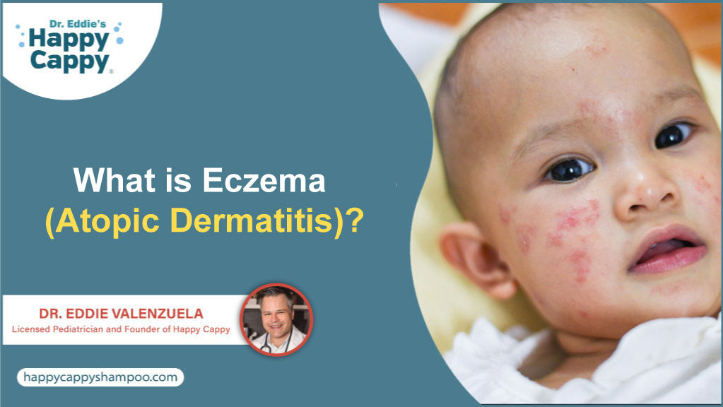 What Is Eczema (Atopic Dermatitis)?