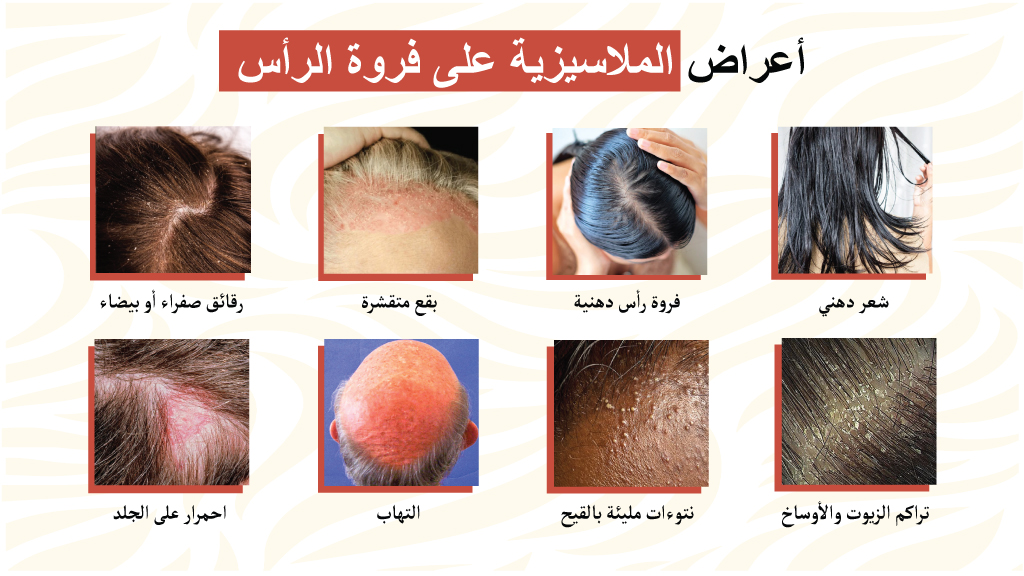 أعراض الملاسيزية على فروة الرأس  