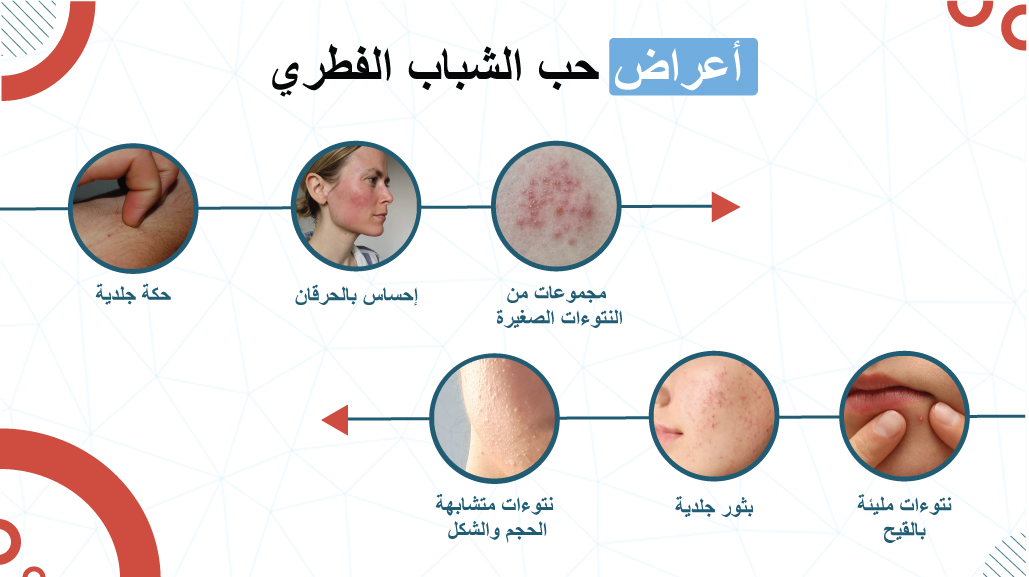 أعراض حب الشباب الفطري