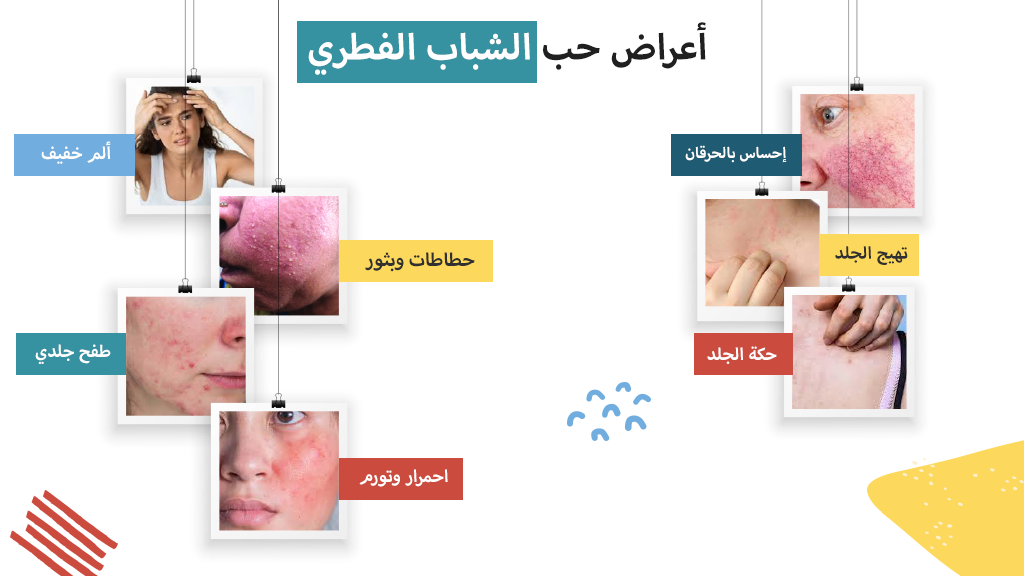 أعراض حب الشباب الفطري