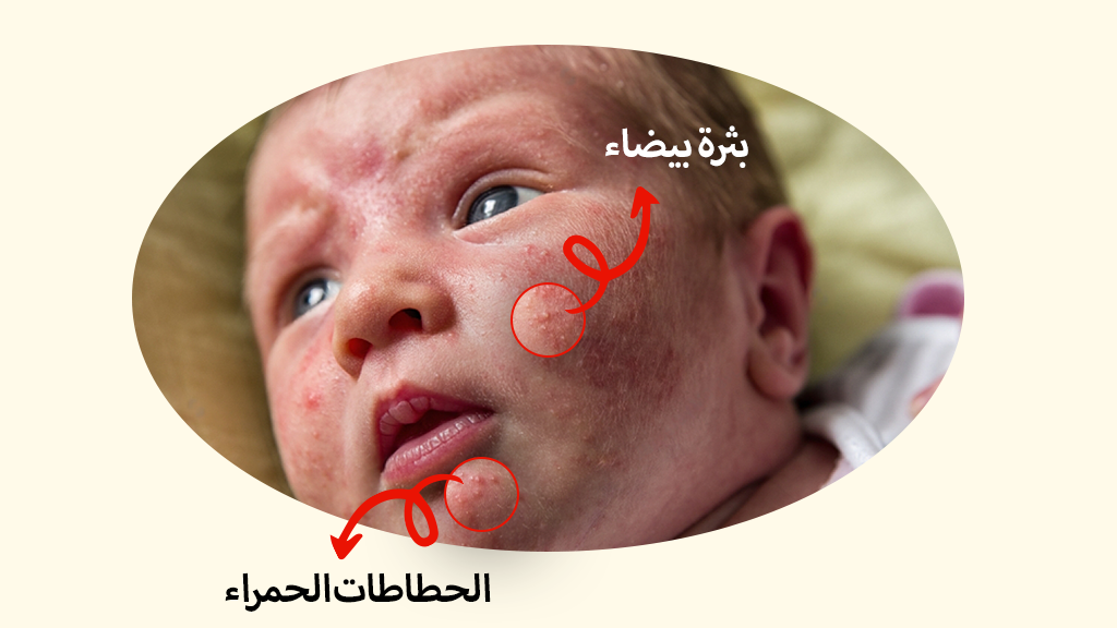 أعراض حب الشباب الوليدي