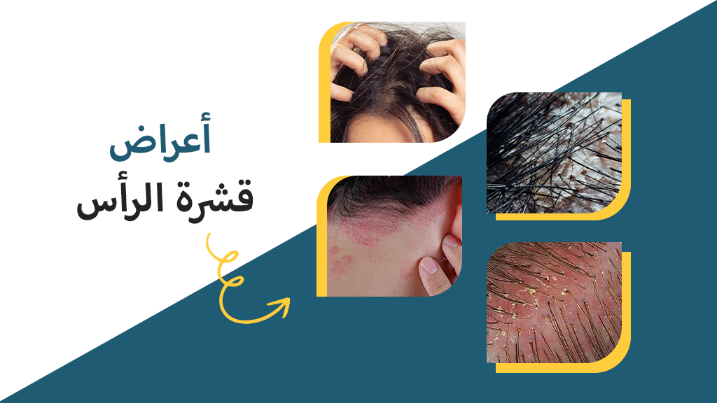 أعراض قشرة الرأس