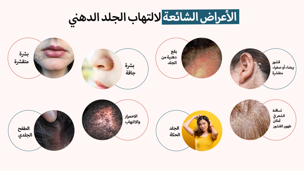 الأعراض الشائعة لالتهاب الجلد الدهني