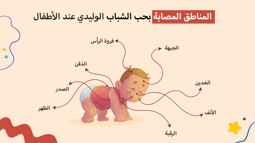 المناطق المصابة بحب الشباب الوليدي عند الأطفال