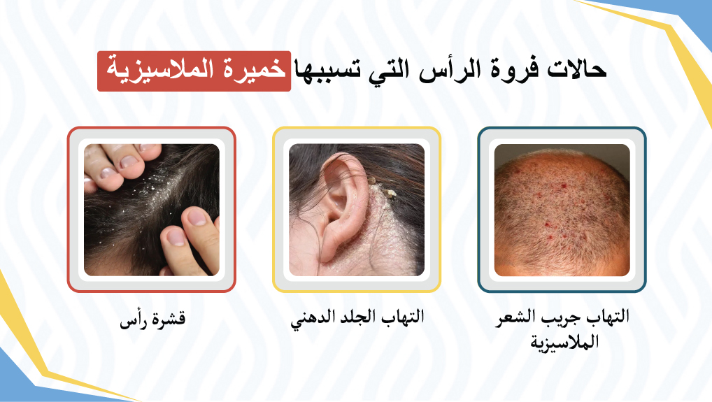 حالات فروة الرأس التي تسببها خميرة الملاسيزية  