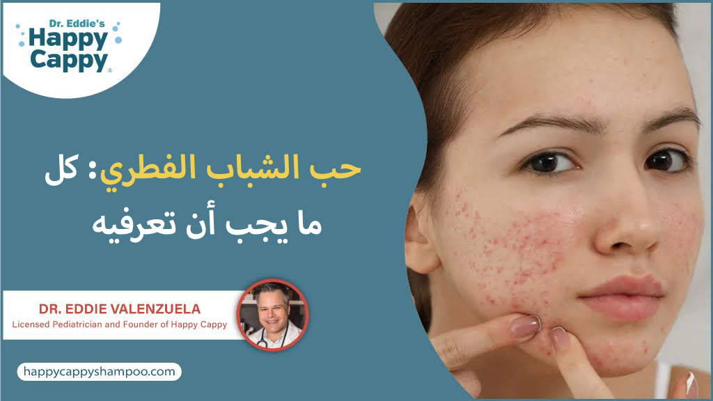 حب الشباب الفطري: كل ما يجب أن تعرفيه