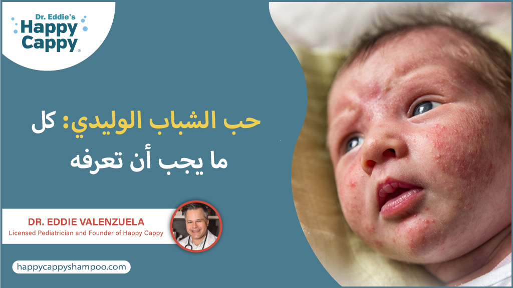 حب الشباب الوليدي: كل ما يجب أن تعرفه
